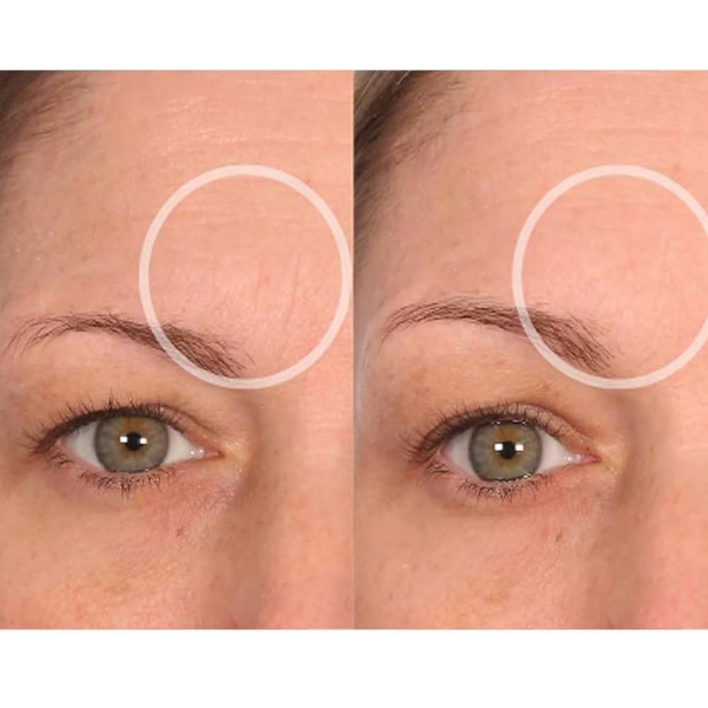 SiO Beauty FaceLift Reusable Anti-Wrinkle Patches for Neck, Forehead, Eye, Smile - Picture 4 of 5